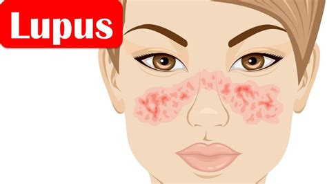 Lupus Slesystemic Lupus Erythematosus Causes Pathogenesis