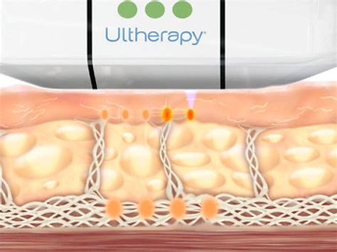 Ultherapy® Singapore Non Invasive Skin Lifting