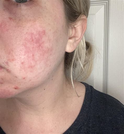 Skin Concerns I Always Have A Patch Of Red Dry Painful Bumps On My