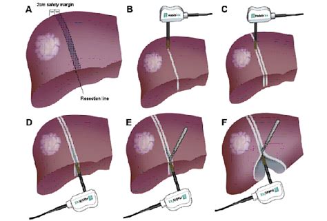 Laparoscopy Purpose Procedure And Recovery Liver Resection Surgery