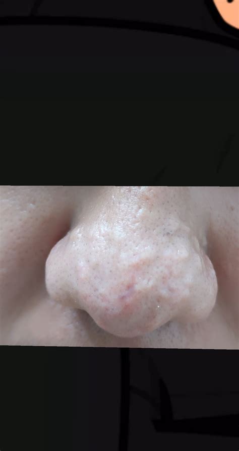 Bumps On Nose Need Helpsuggestionsadvice Hypertrophic Raised