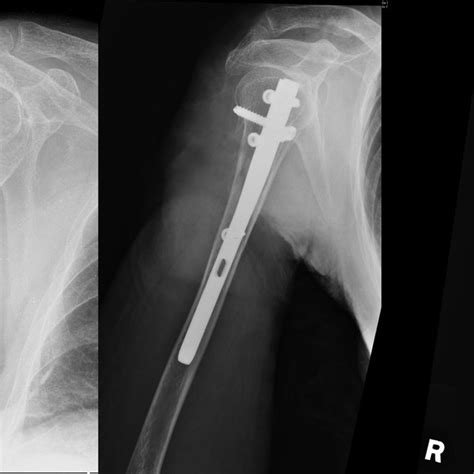 Neers Classification Of Proximal Humeral Fractures Modified From Neer