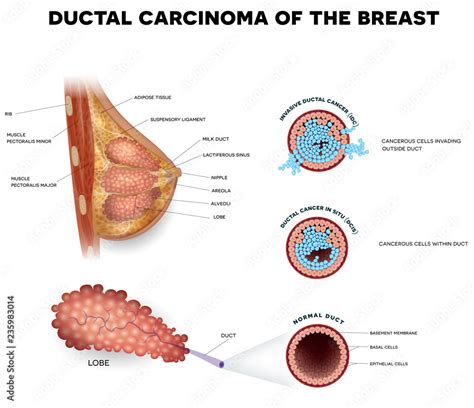 Ductal Carcinoma Of The Breast Detailed Medical Illustration Ductal