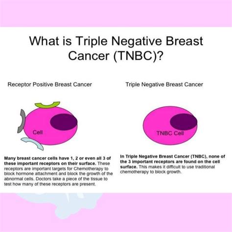 Triple Negative Breast Cancer Stage 1