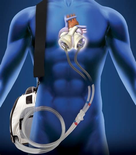Surgeons Perform First Total Artificial Heart Bridge To Transplant In