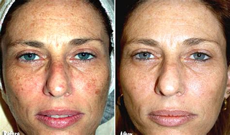 Ipl Photo Facial Before And After Photos Orange County