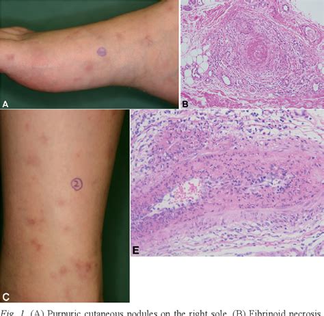 Figure 1 From Significance Of Two Skin Biopsy Performances With