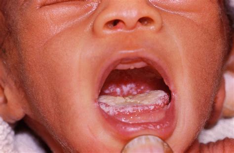 Oral Thrush In Aids Baby Photograph By Dr Ma Ansaryscience Photo Library