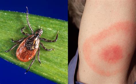 Next generation Lyme disease tests found efficacious and ready for ...