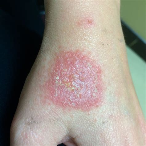 Fungal Infection With Pain On Hand