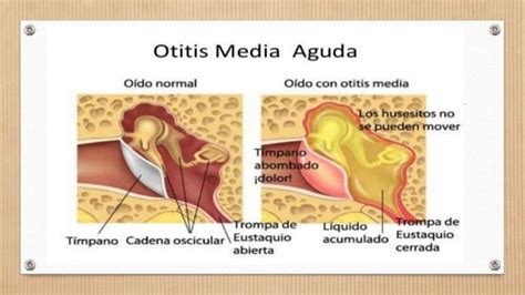 Otitis Media Aguda