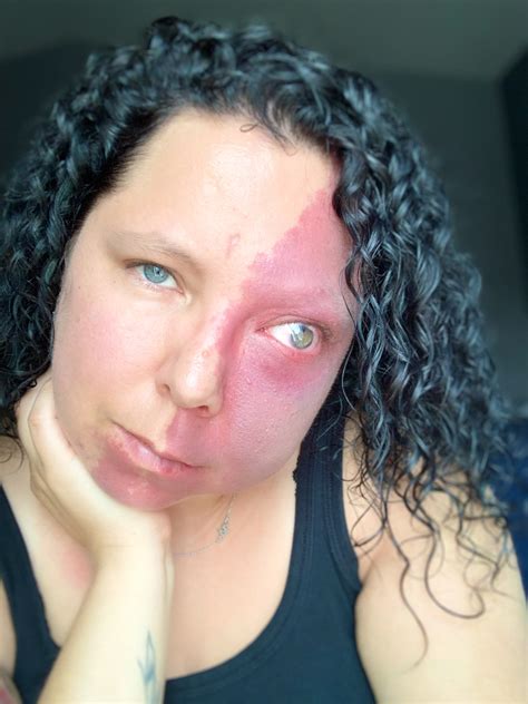 Mom Who Was Bullied For Facial Birthmark Thought Shed Never Find Love