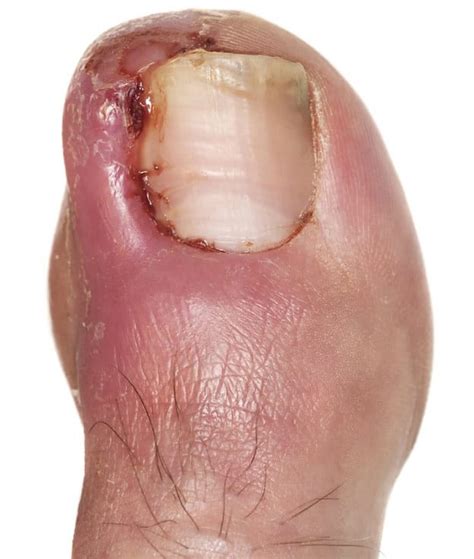 Ingrown Toenail Causes Remedies Prevention And Treatment