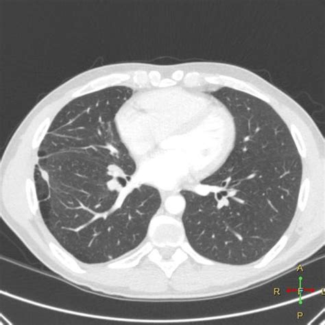 Bullous Emphysema Radiology Case
