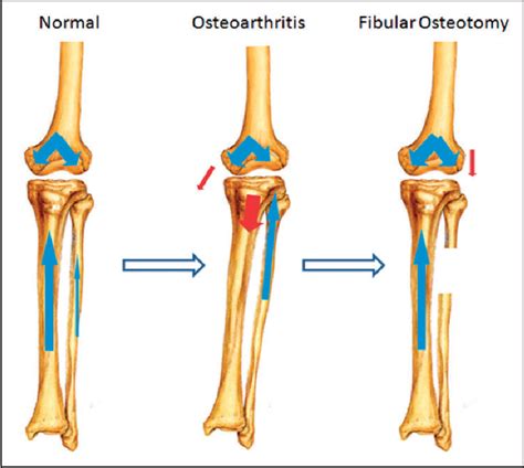 Figure 6 From Proximal Fibular Osteotomy A New Surgery For Pain Relief