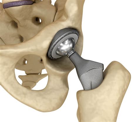 Study Revision Surgery Rate For Metal On Metal Hips On Rise