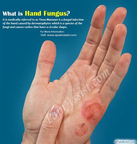Hand Funguscausessymptomstreatmenthome Remedy