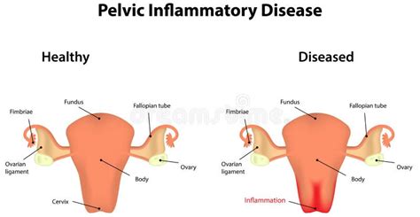Pelvic Inflammatory Disease Stock Vector Illustration Of Disease