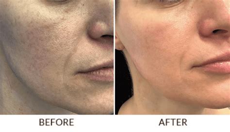 Micro Needling With Prp Bismarck Nd Pure Skin Aesthetic And Laser Center