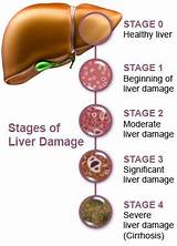 Poor Liver Health Symptoms Pictures