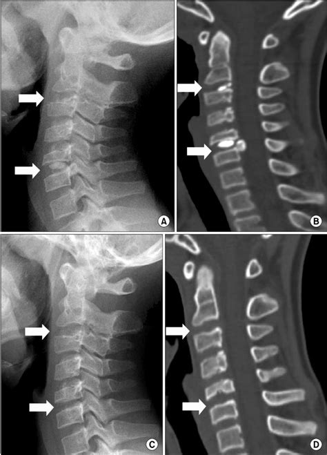Cervical Herniated Disc X Ray