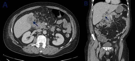Cureus A Case Of Gallbladder Adenocarcinoma Presenting As Mirizzi