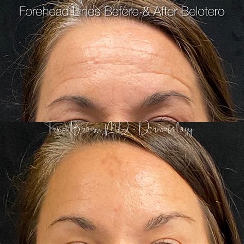 Forehead Line Filler Houston Tx Dermatologist