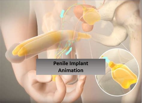Ed Treatment Penile Implants Hardfacts Com Au