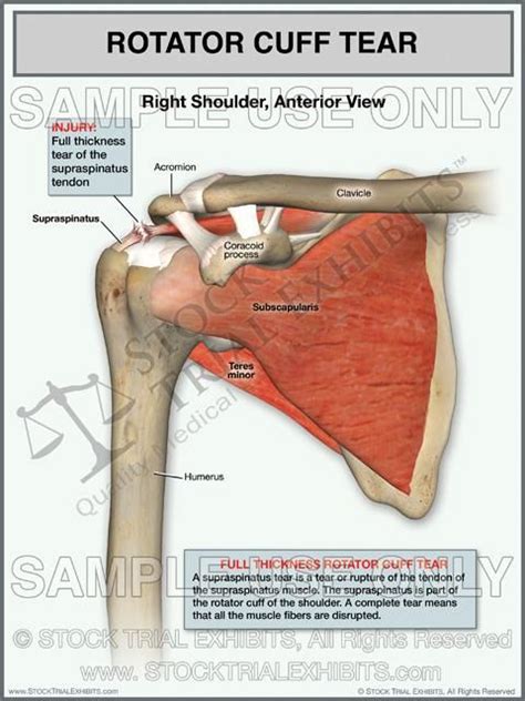 Rotator Cuff Full Thickness Tear Of The Right Shoulder Stock Trial