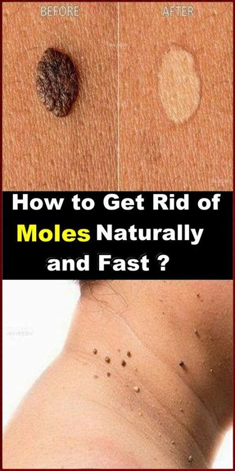 Home Remedies For Skin Tags In 2020 Skin Moles Mole Removal Mole