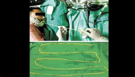 Doctors Remove 6 Foot Tapeworm Through Mans Mouth