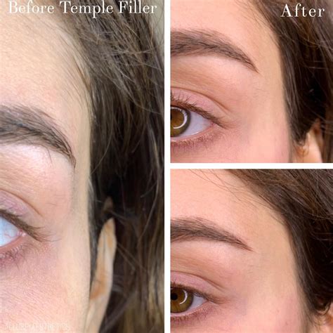 Temple Brow Lift Fillers As Allure Aesthetics Notting Hill