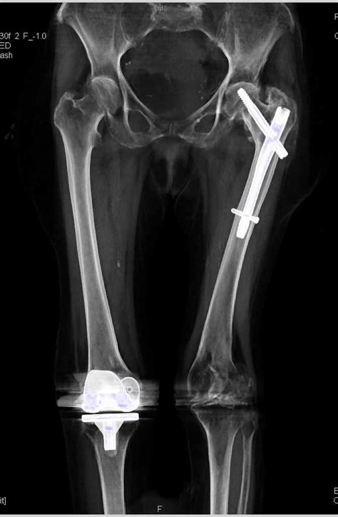Left Distal Femur Fracture In Patient With Hardware Musculoskeletal