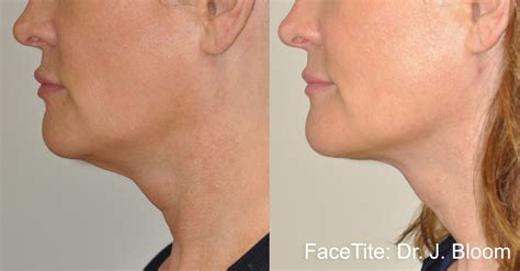 Facetite Guthrie Facial Plastic Surgery Tn