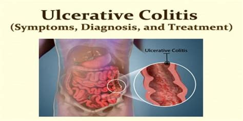 Ulcerative Colitis Symptoms Diagnosis And Treatment Assignment Point