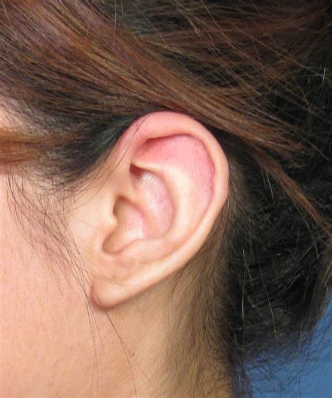 Macrotia Ear Otoplasty Surgery To Reduce Large Prominent Ears