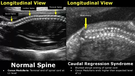 Fetal Spine Ultrasound Normal Vs Abnormal Image Appearances Spinal
