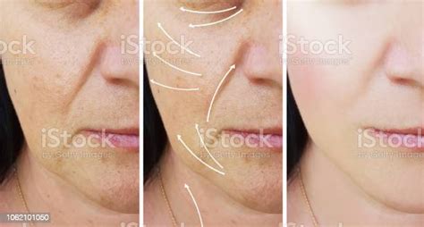 Woman Face Wrinkles Correction Before And After Procedures Arrow Stock