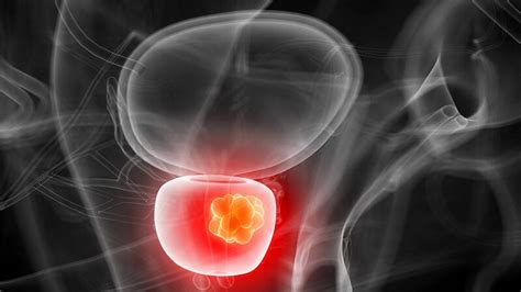 Immunotherapy Combo Active In Metastatic Prostate Cancer