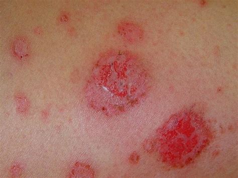 Discoid Eczema Nummular Eczema