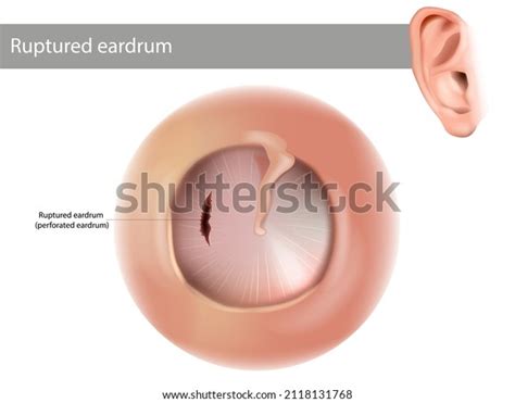 Complete Tympanic Membrane Perforation