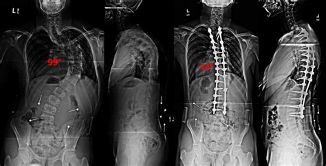 Scoliosis Spinal Fusion