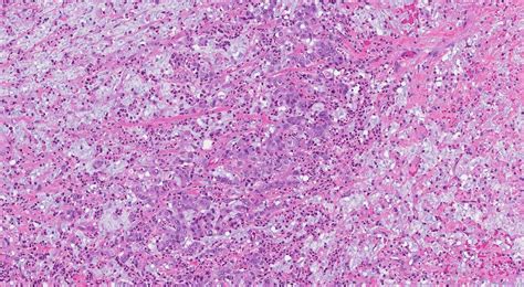 Goblet Cell Adenocarcinoma Archives Atlas Of Pathology