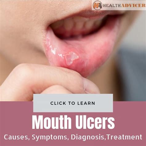 Rarely, the same virus (herpes simplex) that causes cold sores can cause recurring pin head size ulcers inside the mouth occurring in the same place each. Mouth Ulcers: Causes, Picture, Symptoms, Diagnosis and ...