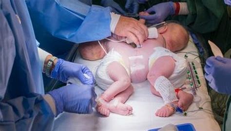 Conjoined twins successfully separated