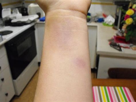 Wrist Bruise By Bottle Fame On Deviantart