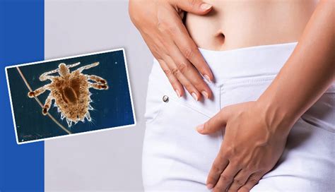 9 Home Remedies To Help You Get Rid Of Pubic Lice