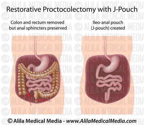 Alila Medical Media Right Hemicolectomy With Ileocolic