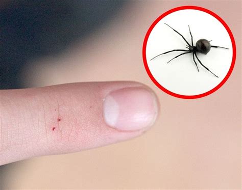 Pin On Bug Bites