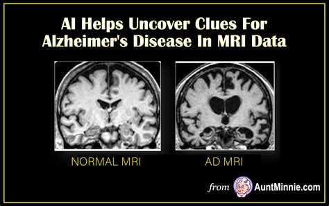 Ai Helps Uncover Clues For Alzheimers Disease In Mri Data Medical X